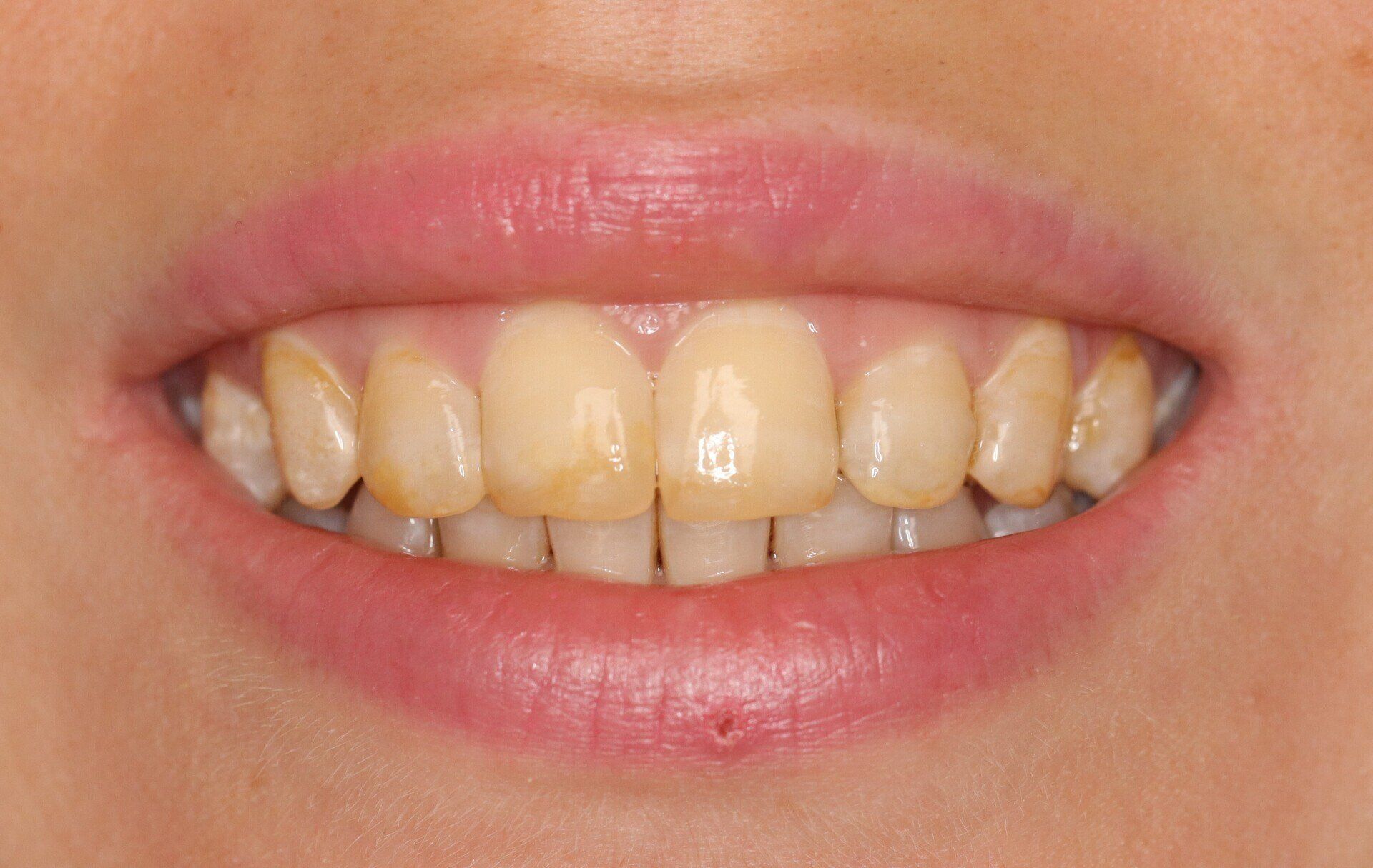 Close up image of a teeth | best dentist for teeth whitening in Escondido 92026