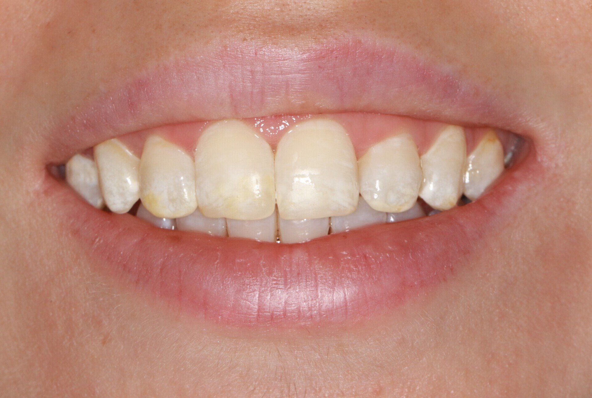 Close up image of a teeth | best dentist for teeth whitening in Escondido 92026