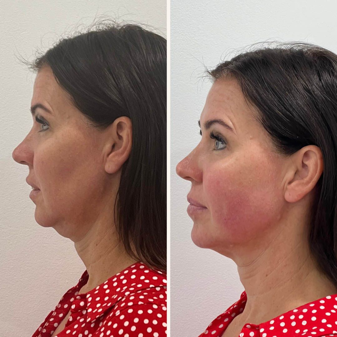 Dermal Fillers Wollongong EVOLVE Skin Aesthetics Clinic