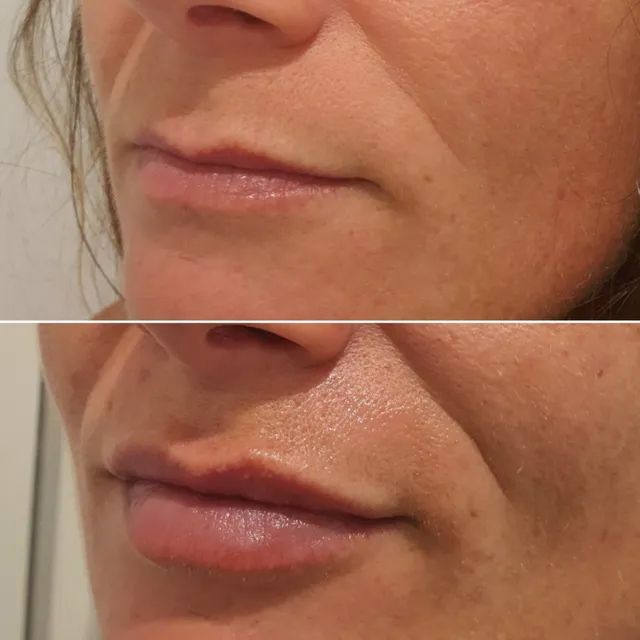 Lip Fillers in Wollongong EVOLVE Skin Aesthetics Clinic