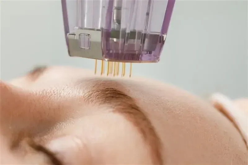 Microneedling device applying treatment to a person’s forehead close-up