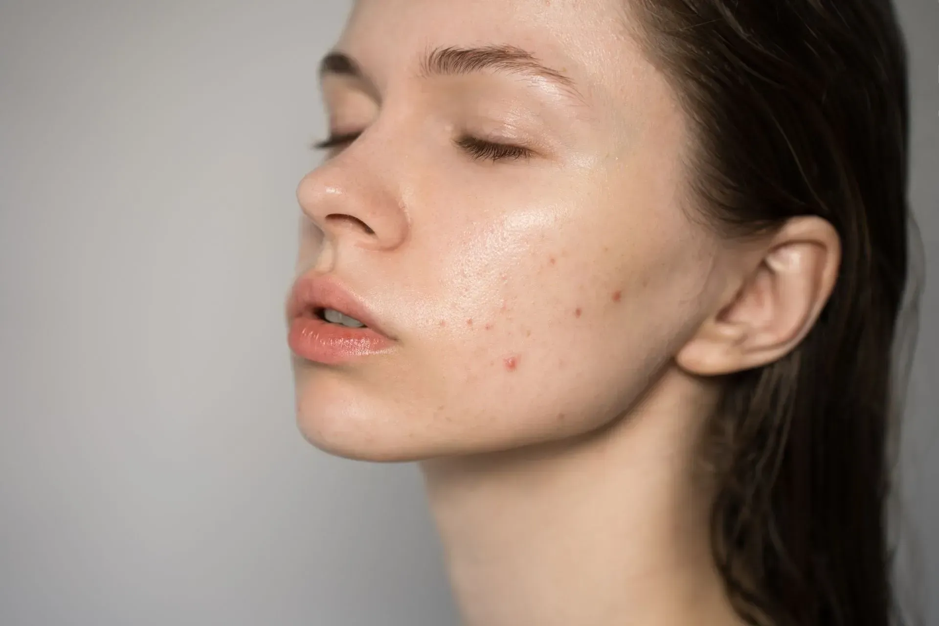 Close-up of a person’s face in profile with visible acne spots on the cheek and chin