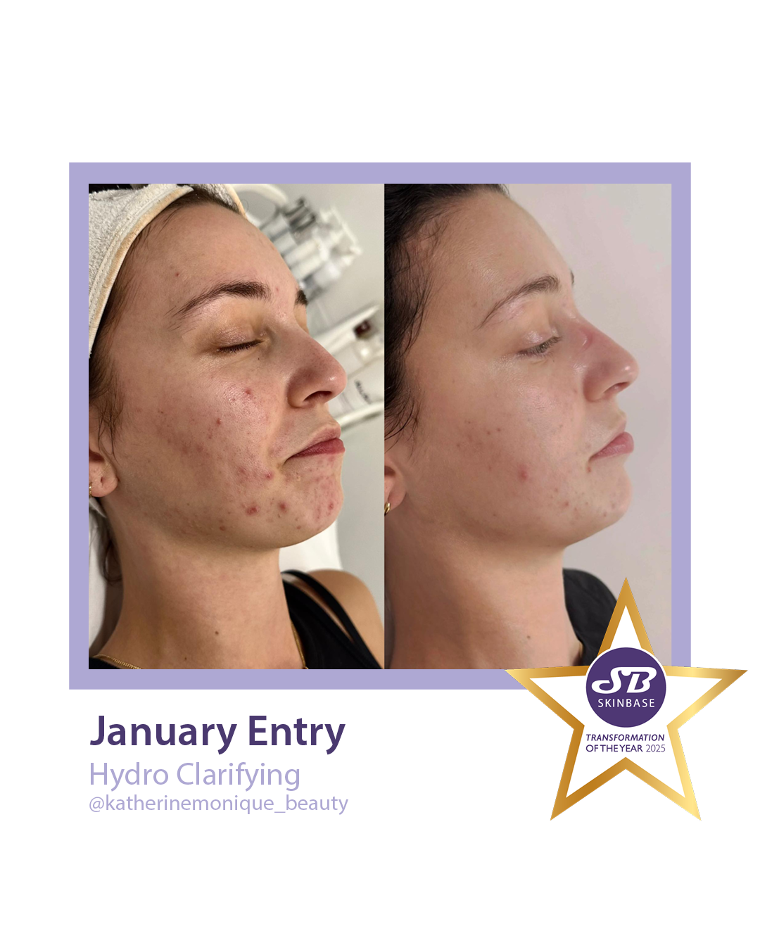 Side-by-side before/after photos of a woman's face, showing skin improvement after Hydra Clarifying treatment.