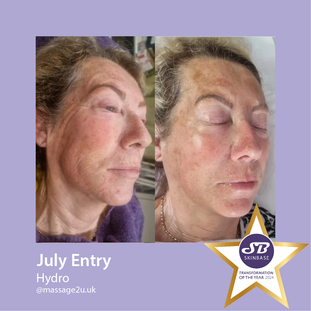 Before and after facial treatment photos of a woman's face. Her skin has less pigmentation.
