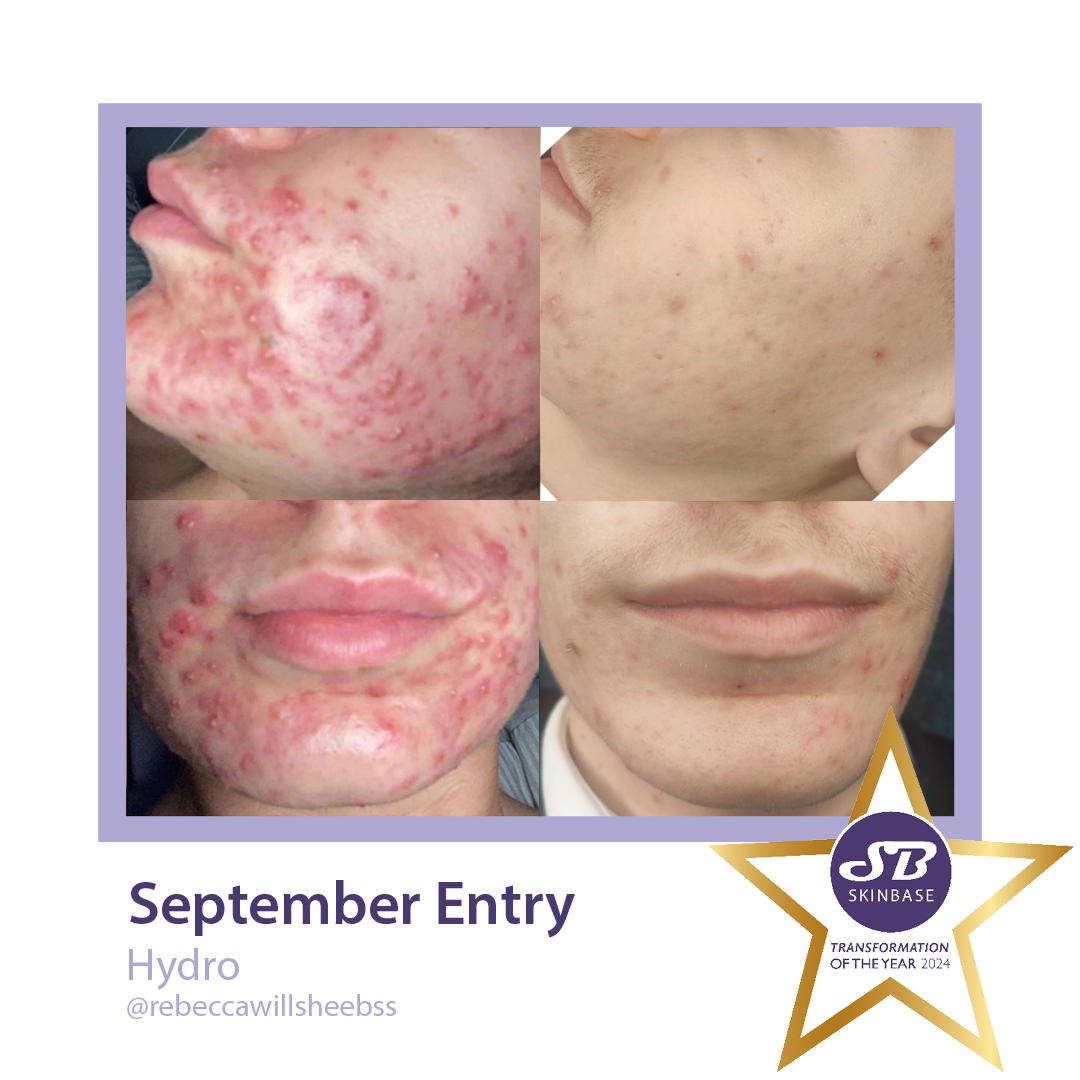 Before and after photos of acne treatment; red blemishes on face, then clear skin.
