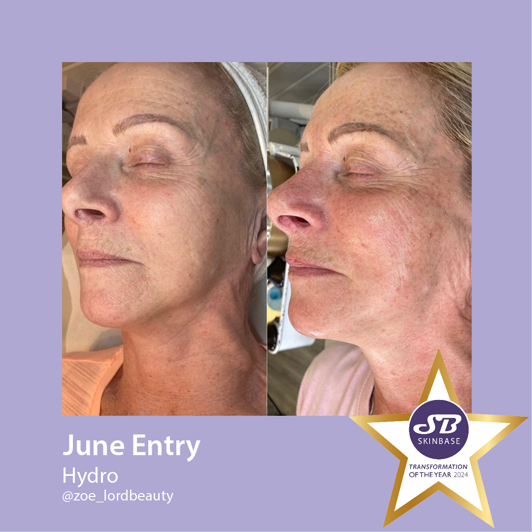 Before and after photos of a woman's face, possibly following a skin treatment, with a lavender background.