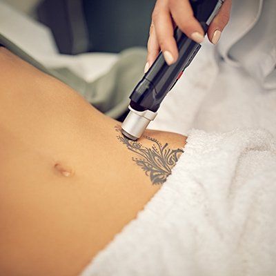 Tattoo Removal — Palm Desert, CA — Cosmetic Laser Solutions Tattoo Removal — Palm Desert, CA — Cosmetic Laser Solutions