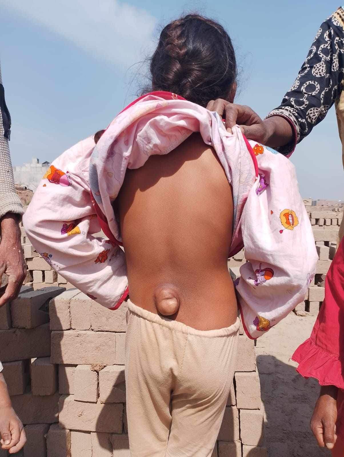 Child with a large, protruding mass on their lower back, standing outdoors; wearing light-colored clothes.