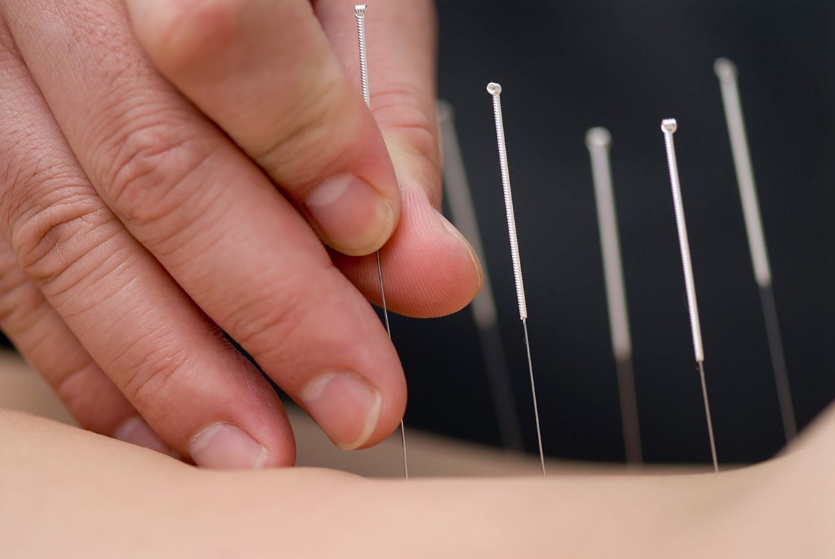 Hands placing an acupuncture needle on a person’s back