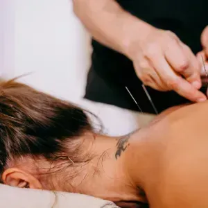 Acupuncture treatment on a woman’s back and neck in a spa setting