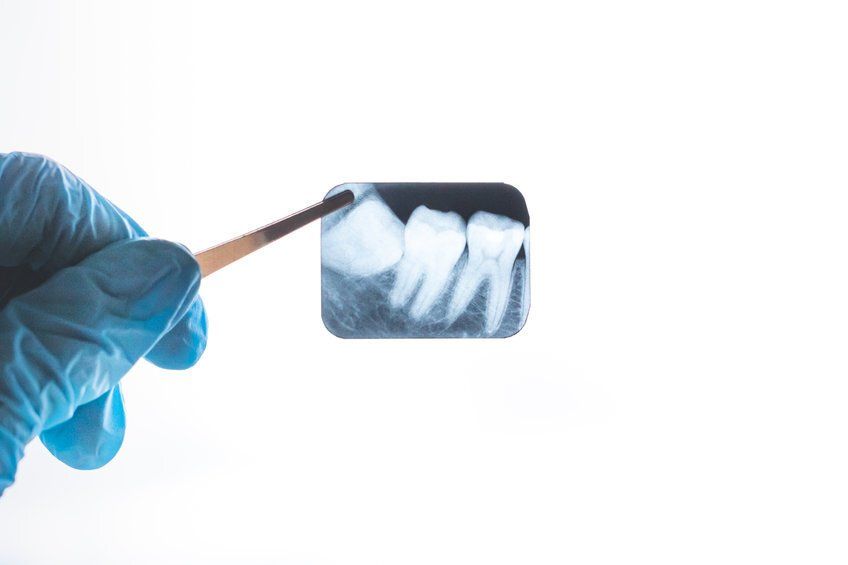 wisdom tooth xray sedation dentist 
