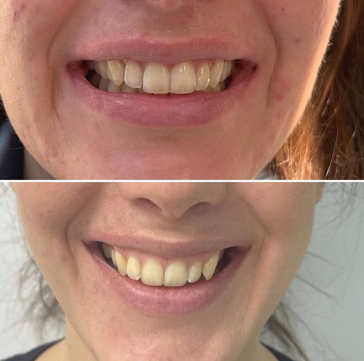  Invisalign Regulering Oslo