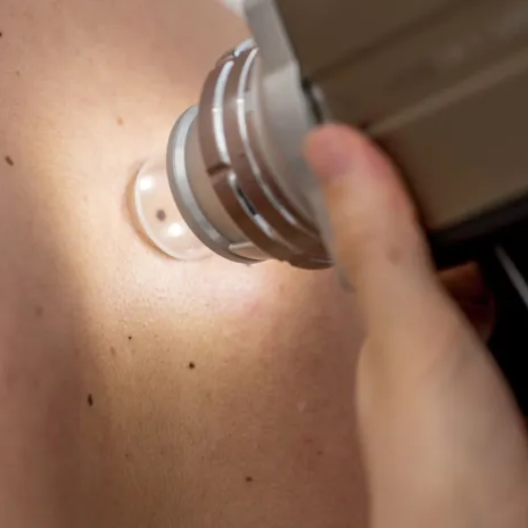 videodermatoscopia