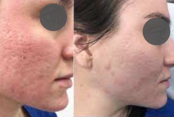 trattamento acne