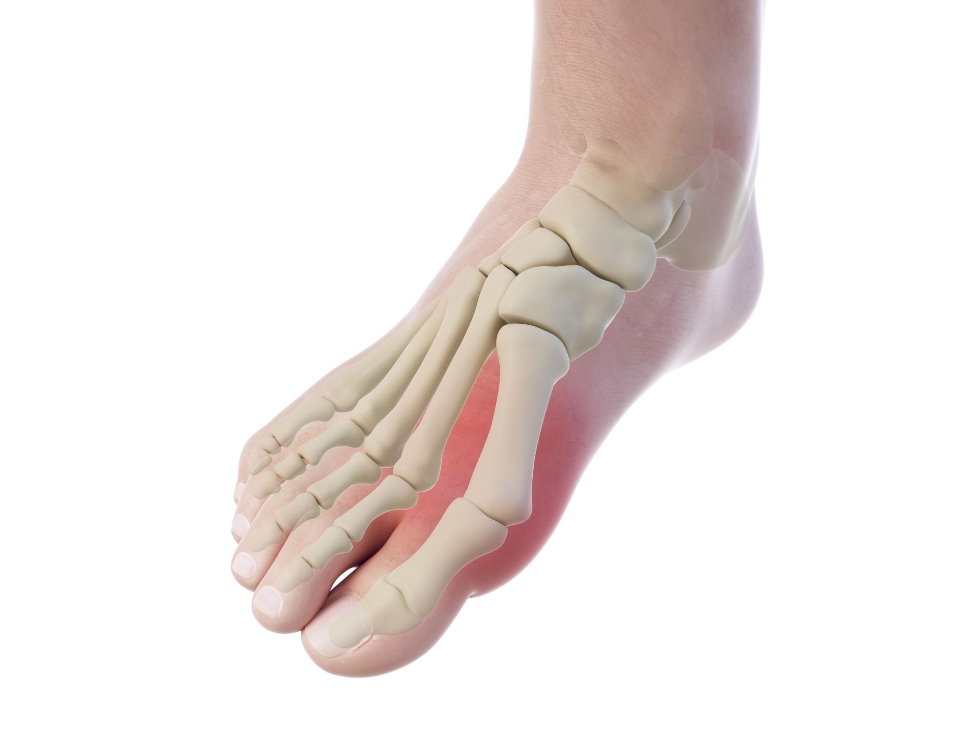 A human foot showing the underlying bone structure with the base of the big toe highlighted in red, indicating inflammation.