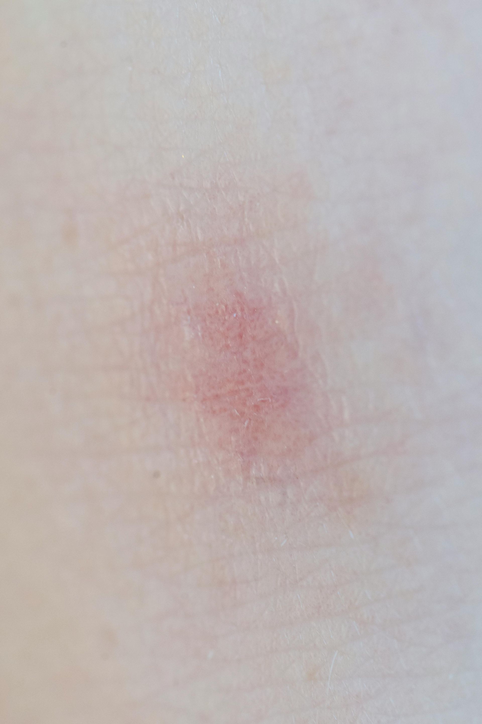 Small red rash on pale skin background