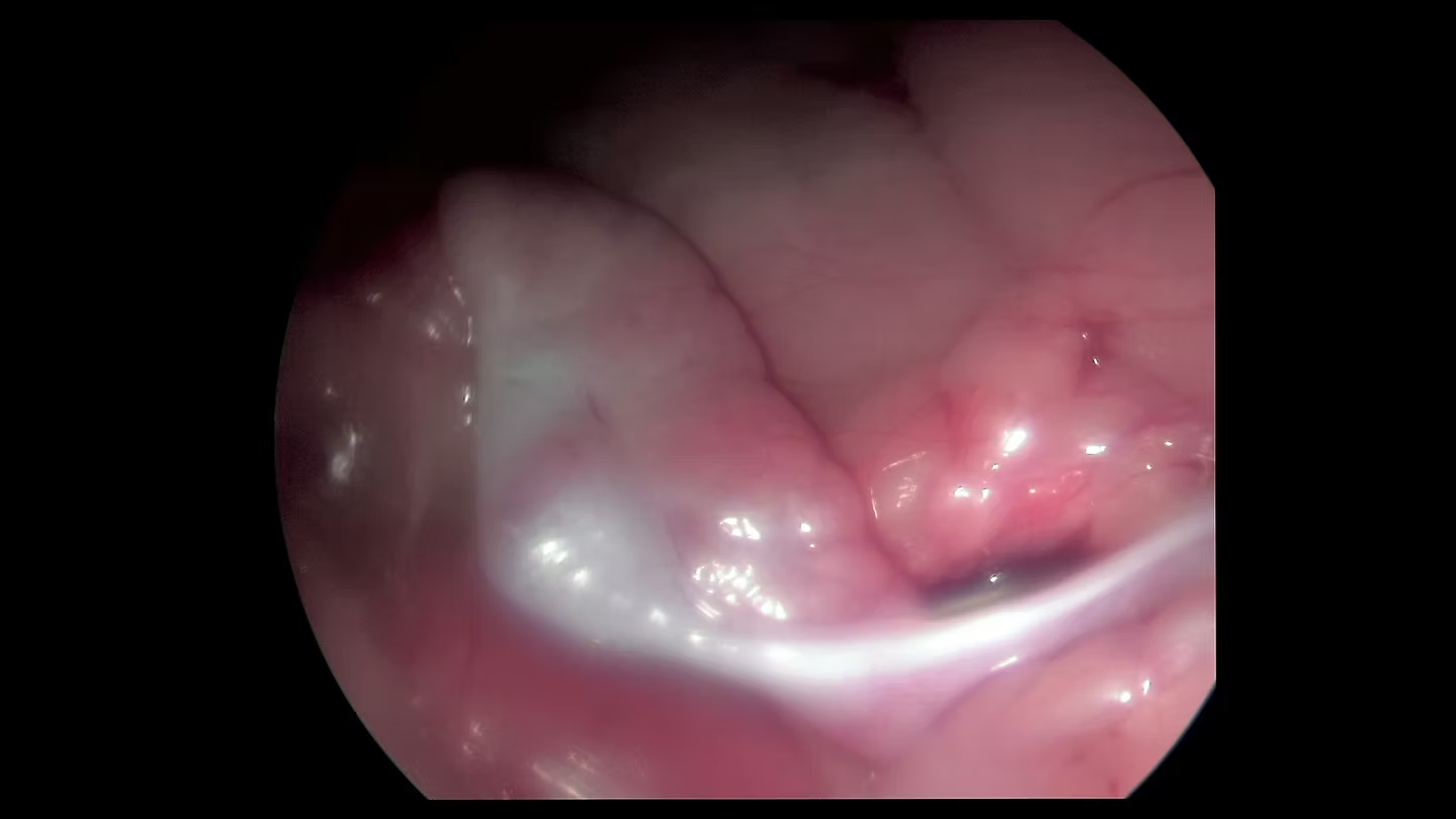 Endoscopic view of pink, fleshy tissue with a bright white area.