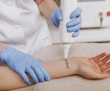Laser Tattoo Removal