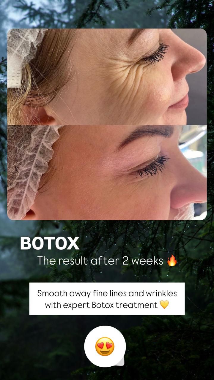 Side-by-side profile photos of a woman before and after Botox, showing smoother skin and fewer wrinkles