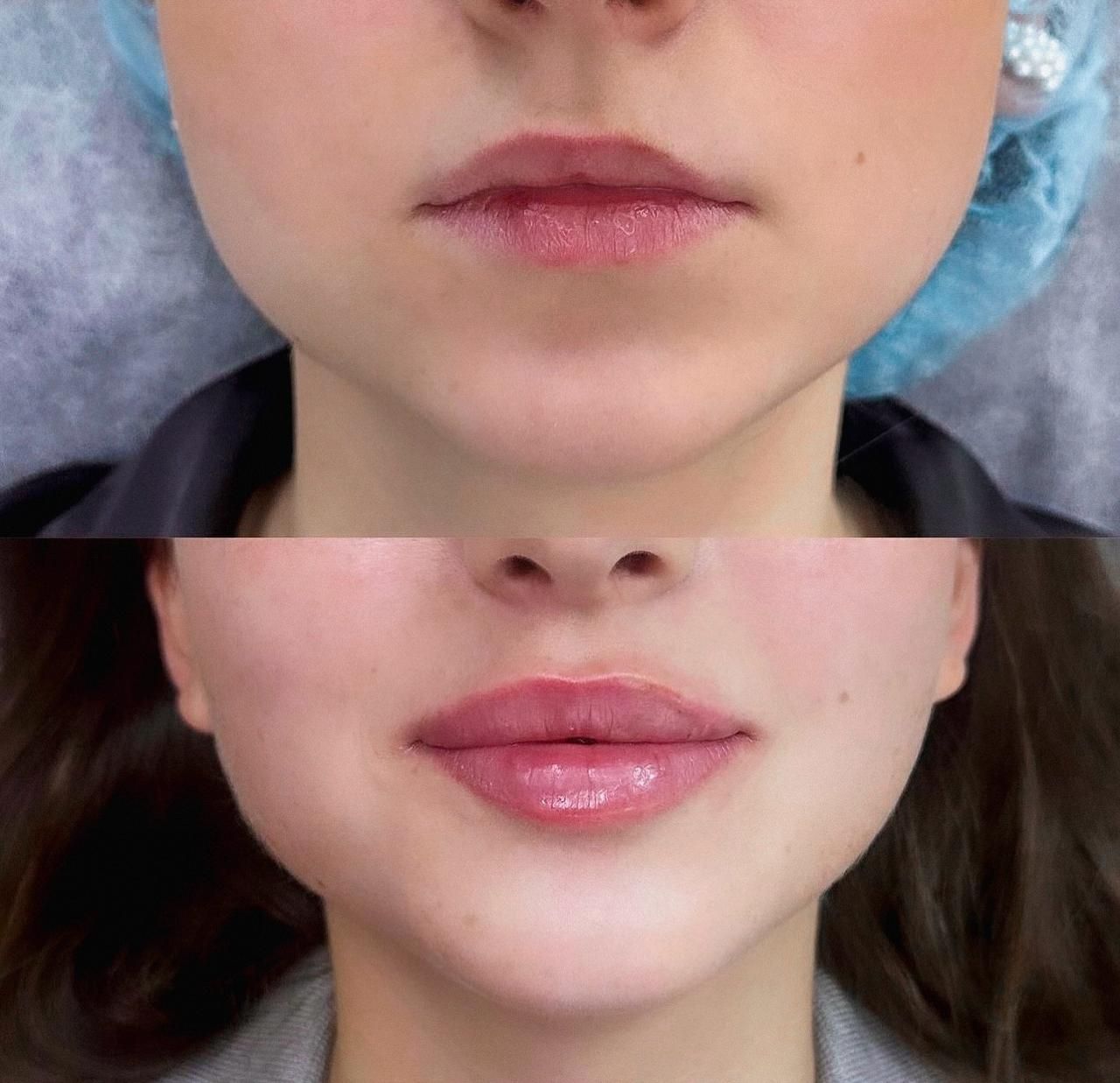 A before and after photo of a woman 's lips.