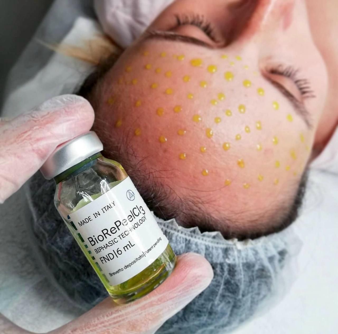 Person undergoing facial treatment, dots of yellow liquid on forehead. Vial labeled 