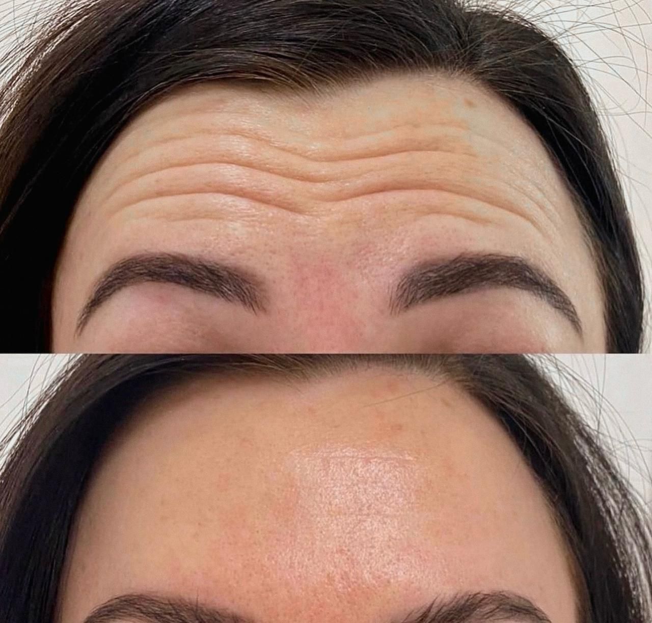 A woman 's forehead before and after botox injections.