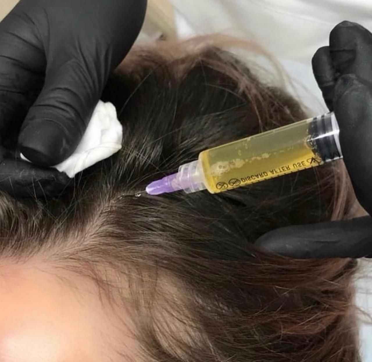 A woman is getting an injection in her hair