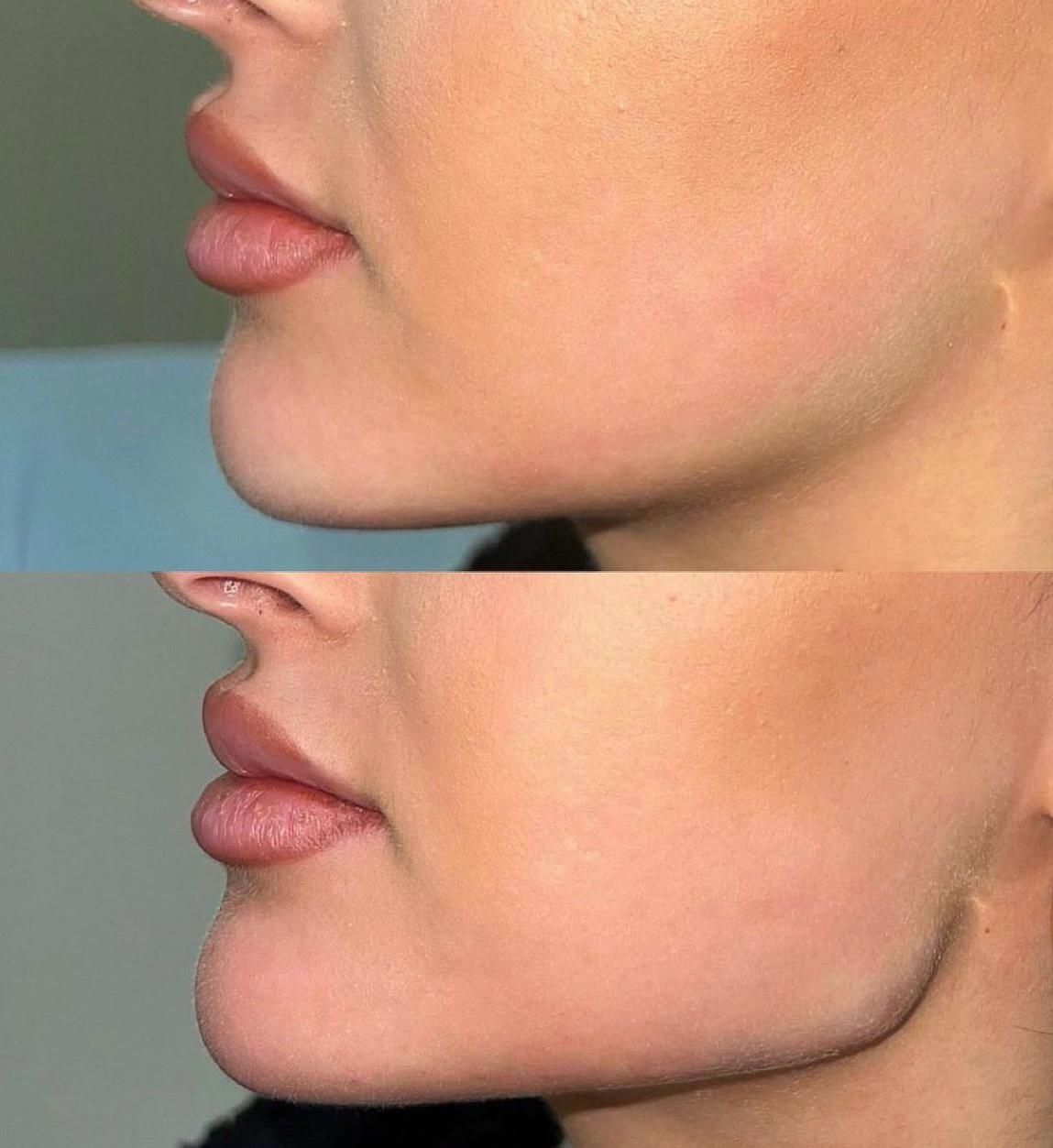 A before and after photo of a woman 's chin.