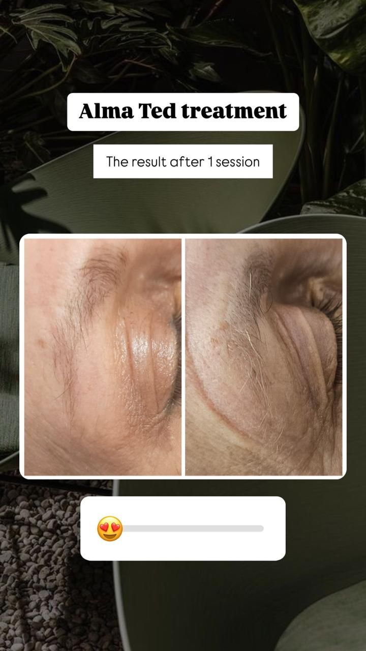 Alma Ted treatment promo with before-and-after close-up skin photos and a heart-eyes reaction