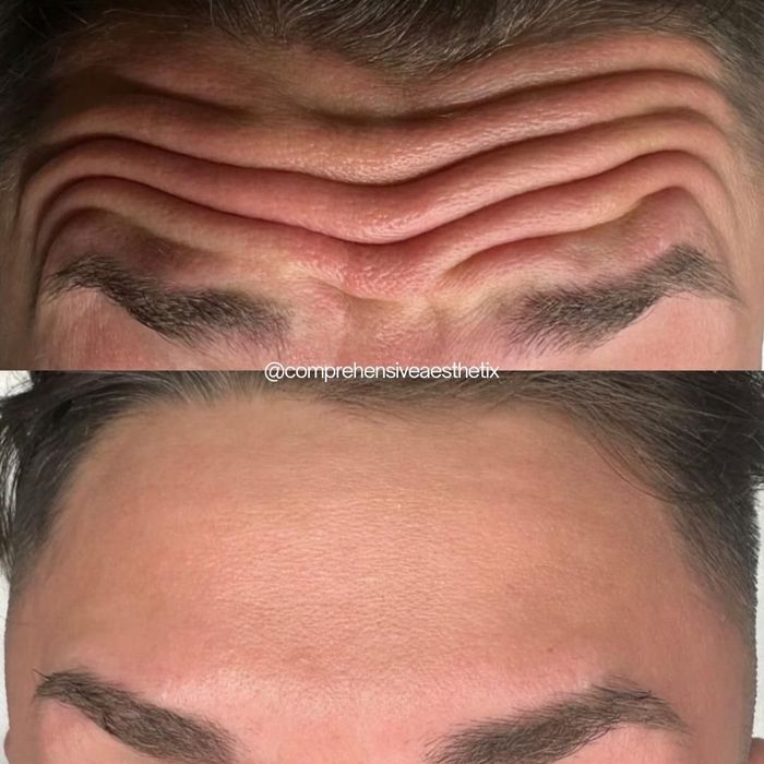 Forehead wrinkles shown before and after smoothing