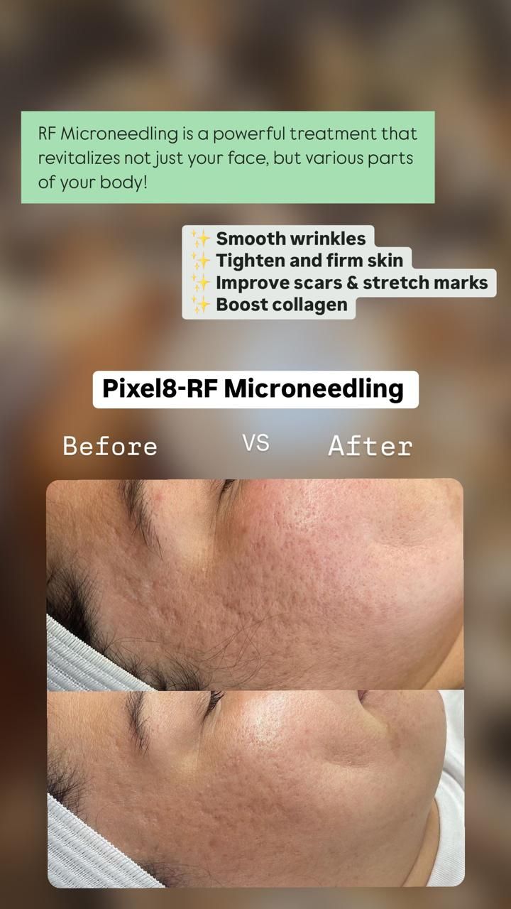 Before-and-after close-up of cheek after Pixel8-RF microneedling, showing smoother skin and reduced acne scars