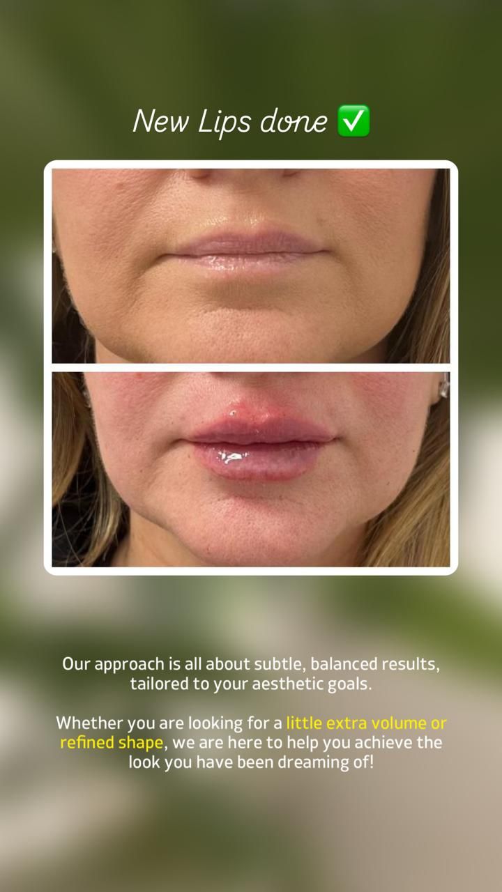 Before-and-after close-up of lips after a lip enhancement procedure, with “New Lips done” text above.