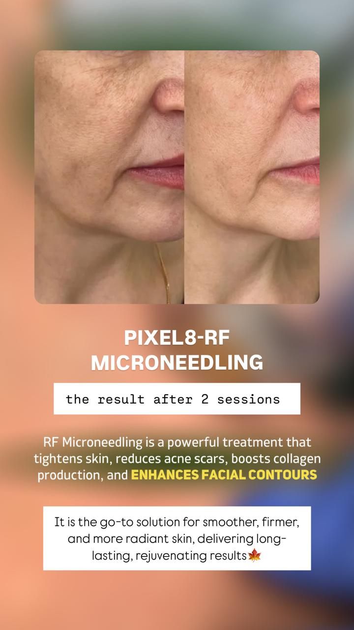 Before-and-after close-up of facial skin showing wrinkle reduction from microneedling.
