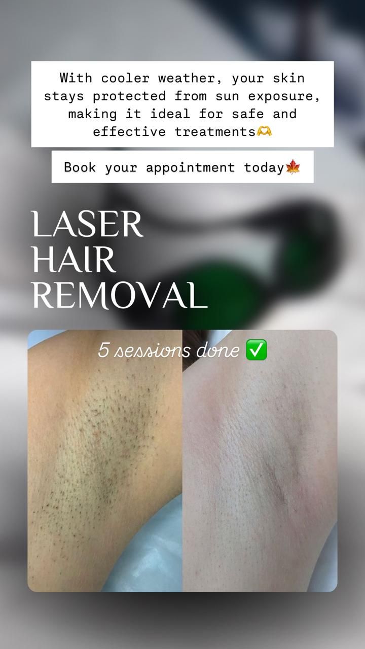 Laser hair removal promo showing before-and-after underarm results and booking text.