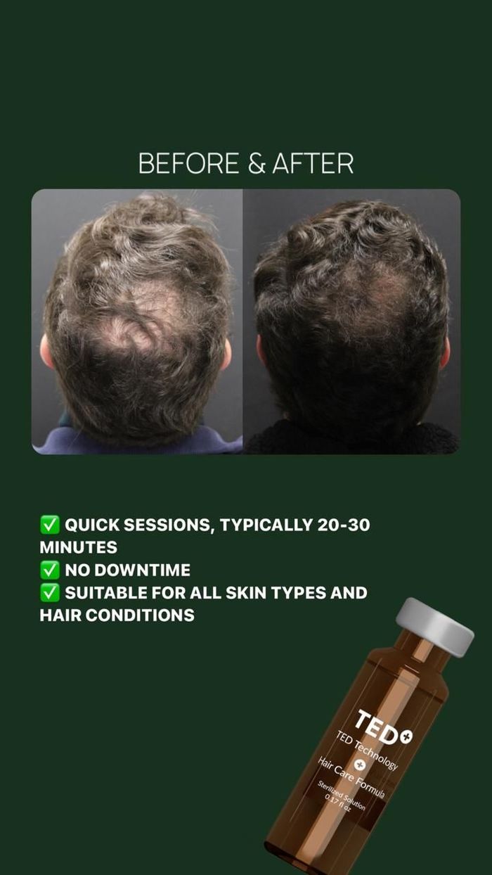Before-and-after scalp photos promoting TED hair serum on a dark green background.