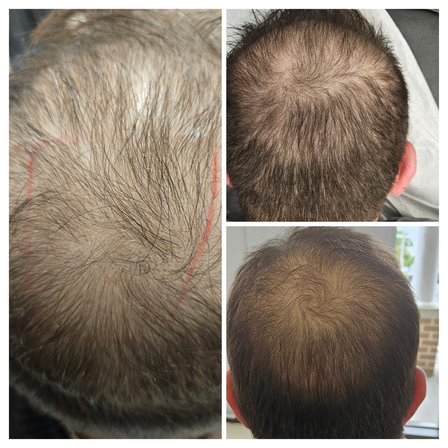 A collage of three pictures of a man 's hair before and after a hair transplant.