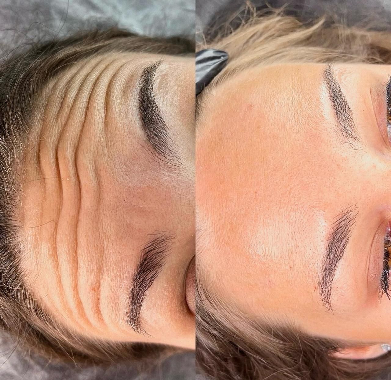 A before and after photo of a woman 's forehead.