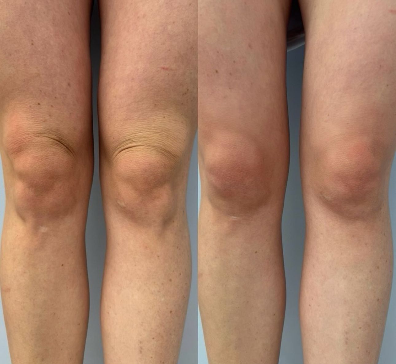 A before and after photo of a person 's knee.