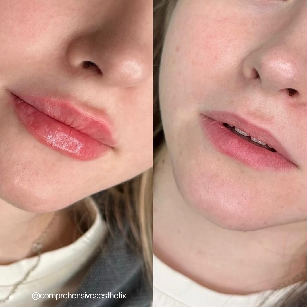 A before and after picture of a woman 's lips.