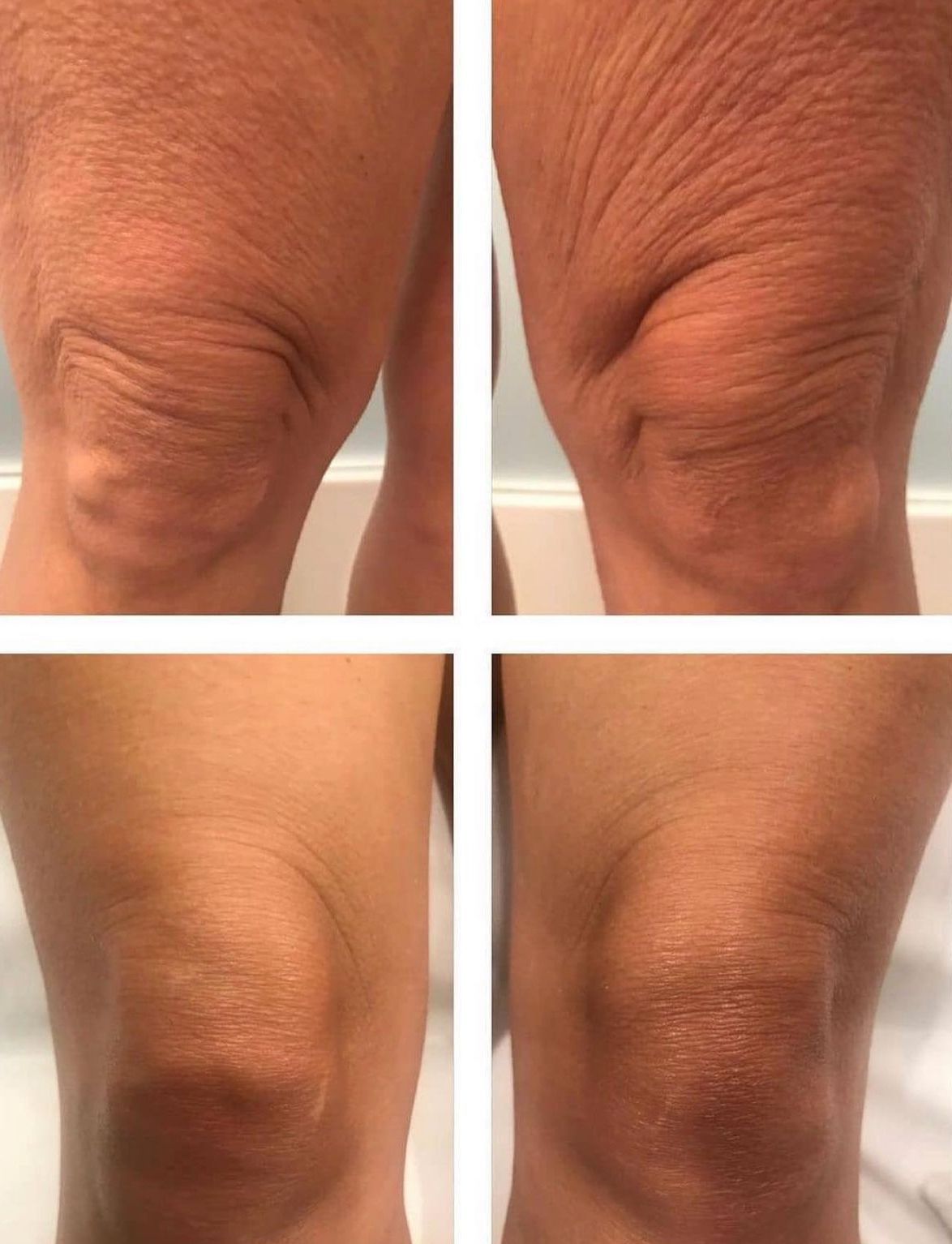 A before and after photo of a woman 's knee.