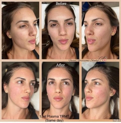 A woman 's face is shown before and after a plasma treatment.