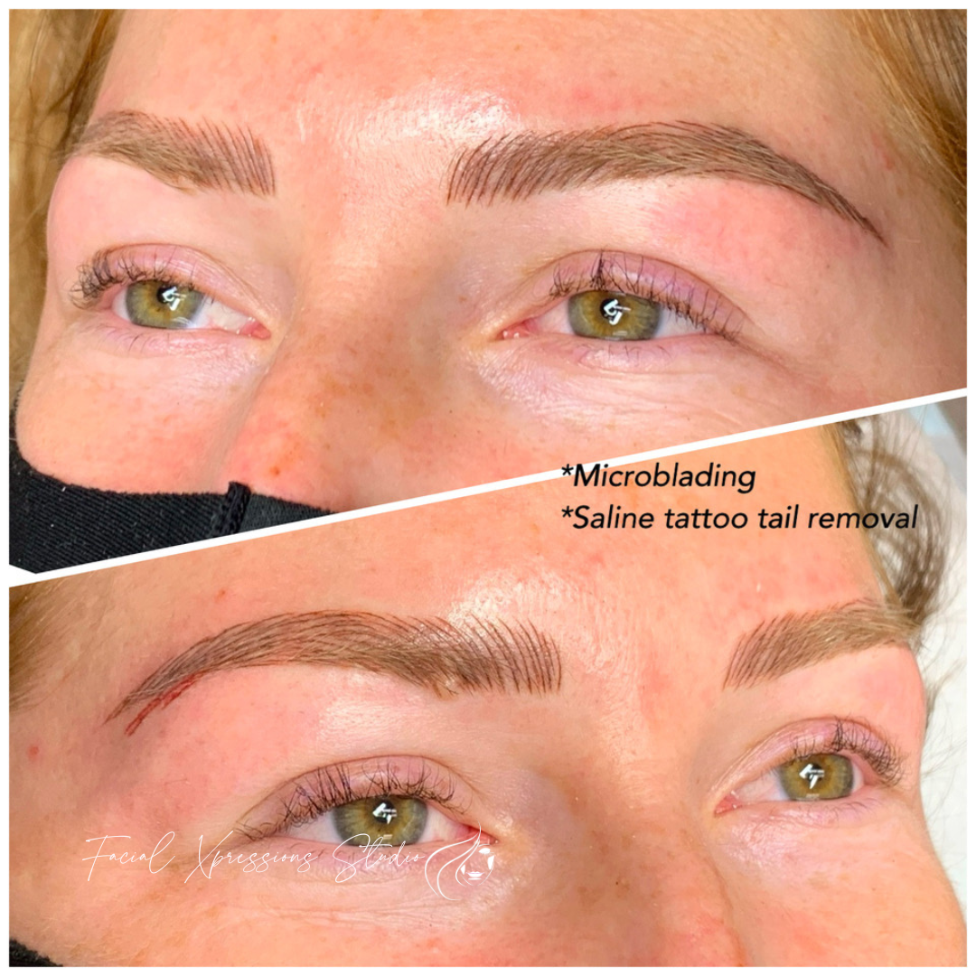 A before and after photo of a woman 's eyebrows with microblading and saline tattoo tail removal.