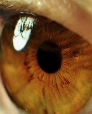 Glaucoma