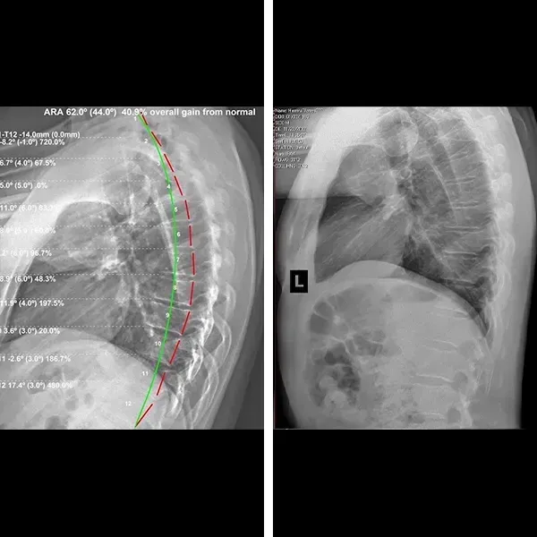 Side-view spinal X-ray with colored curvature lines beside a frontal chest and spine X-ray.