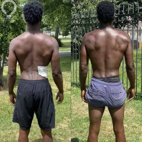 Back view of a shirtless person in a park, shown in a side-by-side before-and-after comparison.