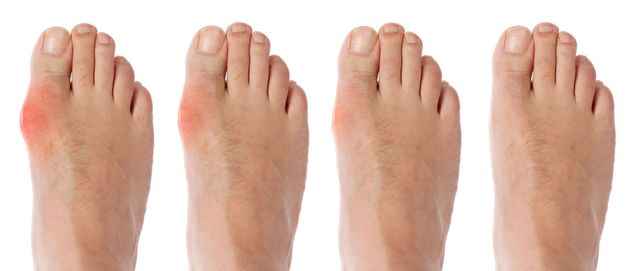 b12 foot injections near me michalwaldmandpm #tampatotalbodycare #fyp #neuropathy #neuropathy #diabetes #medicine #peripheralneuropathy #inflammation #pain #footpain #b12 #b12shots #b12injections B12 Treatments for Peripheral Neuropathy restrictions for b12 foot injection