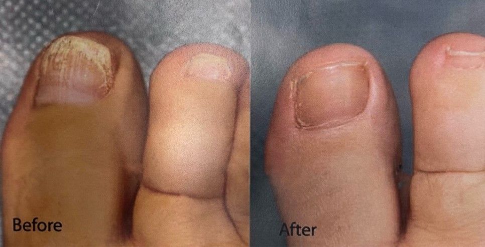 What is Toenail Fungus - Tampa, FL - North Tampa Foot Care What is Toenail Fungus - Tampa, FL - North Tampa Foot Care