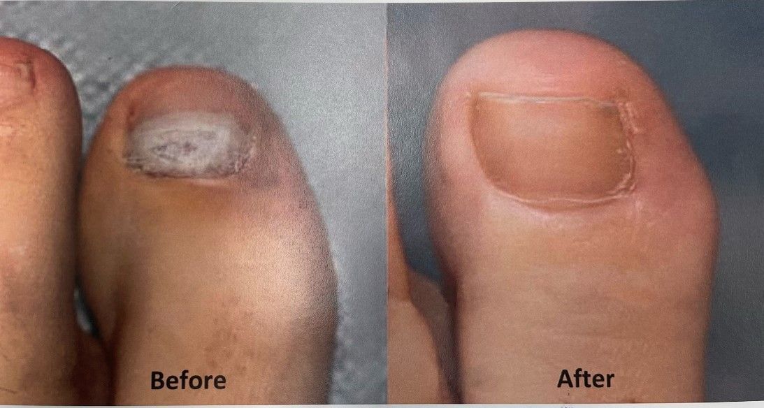 Before and After Pinky Foot Nail - Tampa, FL - North Tampa Foot Care Before and After Pinky Foot Finger - Tampa, FL - North Tampa Foot Care