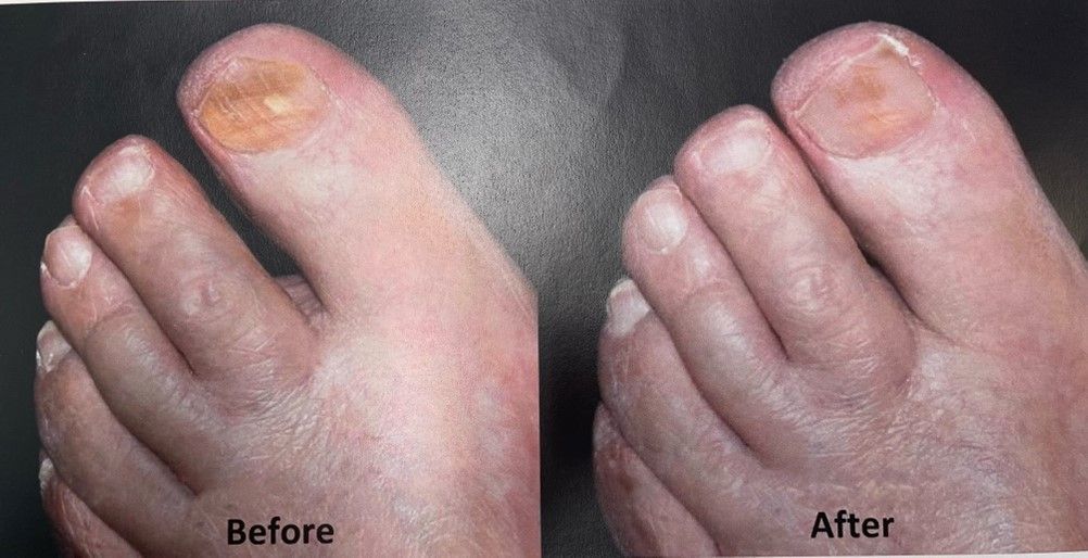 Toenail Fungus - Tampa, FL - North Tampa Foot Care Toenail Fungus - Tampa, FL - North Tampa Foot Care