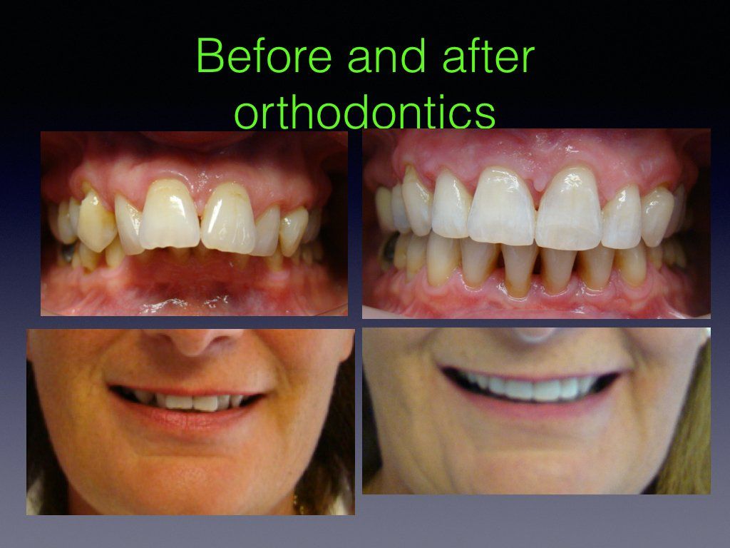 Before & after 1